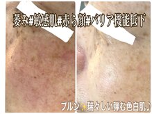 アルページュ(Arpege)/敏感、赤ら顔の悩める乙女も健肌