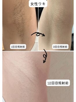 セルフ脱毛サロン SELFMADE イオンタウン仙台泉大沢店【3/29 NEW OPEN(予定)】 /【ビフォーアフター】セルフ脱毛