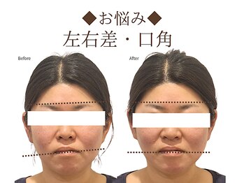 レジスタ(REGISTA)/【小顔矯正】before/after