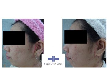 フェイシャルスタイリストサロン 高崎店(Facial Stylist Salon)/ケア例(69)