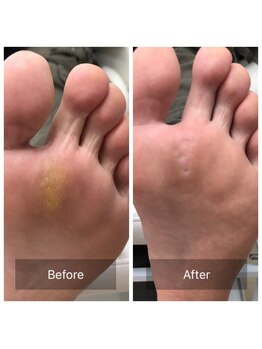 ドクターネイル爪革命 北千住店/たこ、魚の目ケア　足湯あり