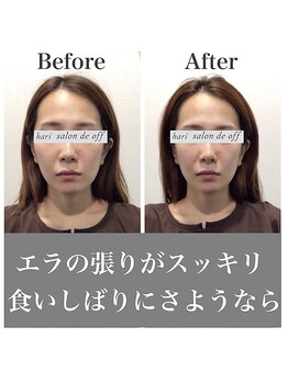 ハリサロンドオフ 心斎橋店(hari salon de off)/食いしばりに効果抜群☆