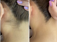 ニコ アンド キャンディー(Nico.&Candy)/うなじ脱毛　ビフォー＆アフター