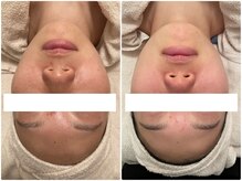 ハイファイブ(Hi-Five)/ポテンツァ/（施術9回）