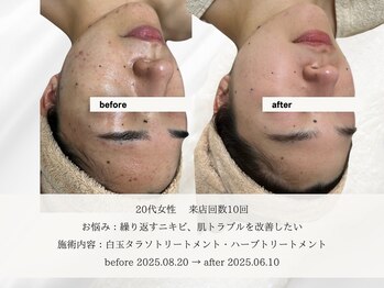 エメ 名古屋栄店(aimer)/SkinCare <肌管理・エイジング>