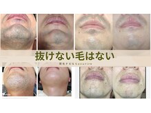 スリール(sourire)の雰囲気（【メンズ脱毛】ヒゲ脱毛/ビフォーアフター/ヒゲ剃り解消/THR方式）