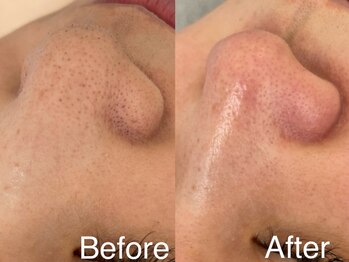 ドラーダ(DORADA)/【毛穴洗浄】毛穴の黒ずみ改善