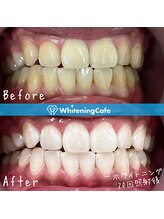 ホワイトニングカフェ 和歌山ガーデンパーク店(WhiteningCafe)/24分×2回照射/7回来店/30代男性