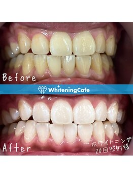 ホワイトニングカフェ 和歌山ガーデンパーク店(WhiteningCafe)/24分×2回照射/7回来店/30代男性