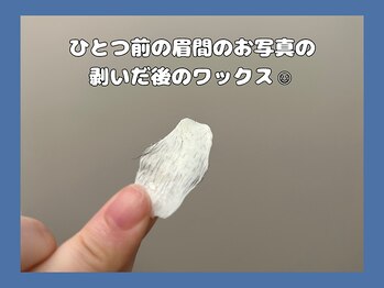 ガミーワックス(gummy wax)/眉間の角栓
