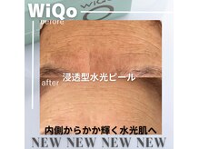 ルアナ(Luana)の雰囲気（草加初登場！！WiQo水光ピーリング☆）