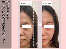 リッツ(RITZ)/【小顔矯正＋肌質改善】症例写真