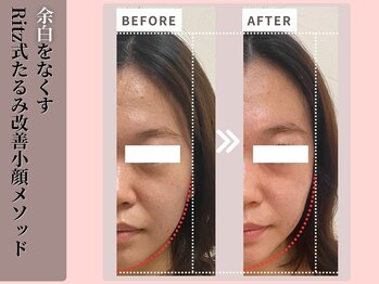 リッツ(RITZ)/【小顔矯正＋肌質改善】症例写真