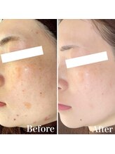 パールホワイトニングサロン 小田原店/肌トラブルやシミケアまで改善