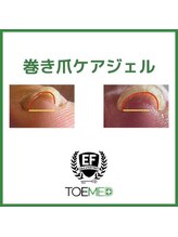 クレセント アイアンドネイル 今泉店(Crescent)/巻き爪改善