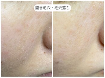 フラックス 京都(FLUX)/【エンビロン】たるみ毛穴コース