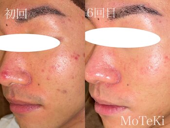 モテキ 表参道店(MoTeKi)/症例Befor/After毛穴