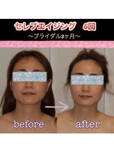 ボディグロス 梅田店(BODY GLOSS)/セレブエイジング　6回