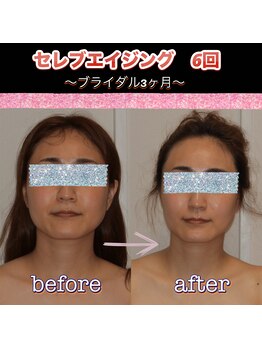 ボディグロス 梅田店(BODY GLOSS)/セレブエイジング　6回