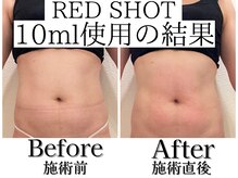 エトワール(etoile)/天王寺あべの脂肪分解10cc