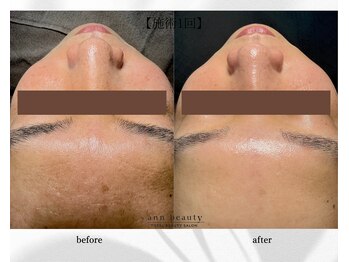 アン ビューティー(ann beauty)の写真/【毛穴ケア人気No.1】毛穴洗浄×プラズマで角栓・くすみオフ◎艶やかな毛穴レス陶器肌に♪ニキビケアにも！