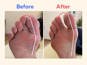 ピース/親指の曲がりでお悩みの50代男性