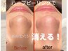 ハーブピーリング【徹底小鼻毛穴ケア】毛穴開き、黒ずみ、毛穴詰まり★
