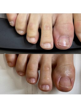 リリ(lili)/トータルフットケア1回目