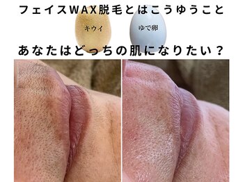 ザ ベッピン(the 別嬪)/光脱毛では無くせない顔の毛