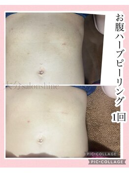 サロンシャイン(Salon Shine)/お腹のハーブピーリング1回