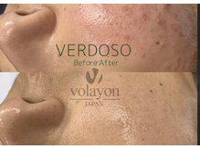 クインティナ(Quintina)/Volayon