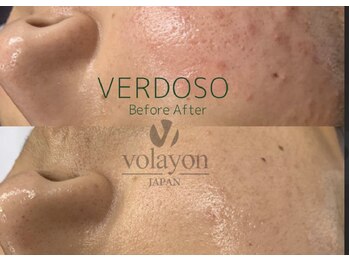 クインティナ(Quintina)/Volayon