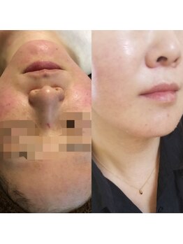 サロンシャイン(Salon Shine)/ハーバルピールレベル4