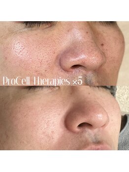 ルチル(Rutile)/プロセルセラピーズ5回