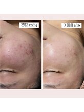 ホワイトアクア 福岡天神店(WHITE AQUA)/ララピールでニキビケアを