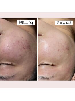 ホワイトアクア 福岡天神店(WHITE AQUA)/ララピールでニキビケアを