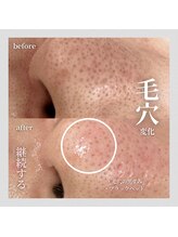 ララ(LaLa.)/毛穴洗浄