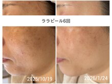 前田さんちのエステサロン ドゥース(douce.)の雰囲気（【Before/After】ピーリング〈ララピール〉6回の結果）