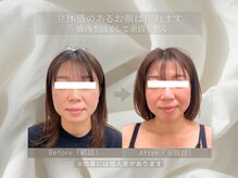 ステップ木更津鍼灸治療院/六本木の小顔矯正技術を木更津で