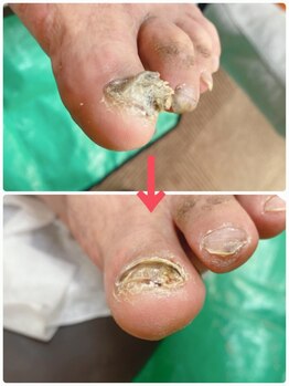 名古屋駅前巻き爪センター/肥厚爪