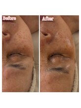 ミラビューティー(Mira Beauty)/60代肌改善事例