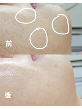 チョンダムビューティー(chondam beauty)/ポレーション導入でくすみ改善