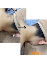 モア(MOA)/うなじ脱毛