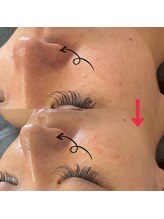 ダリア(Dahlia)/ハーブピーリング