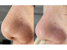 ルヴェール 久屋公園(le verre)/ハイドラフェイシャル+美容液