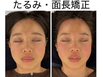 エレヴィザ トウキョウ 恵比寿院(ELVISA TOKYO)/たるみ・面長改善 / 初回施術