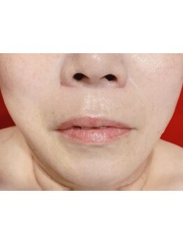 ホウレイ線・たるみ改善！予防ケア