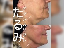 ミリュール(Millule)の雰囲気（強力に引き締めることでリフトアップ小顔に！）