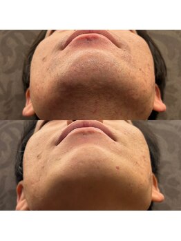 フェリーバ 流山店(FELIVA)/お肌の荒れ、無くせます!