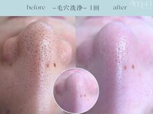 スキンラボアメリ(skin lab. ameri)/韓国式３D毛穴洗浄